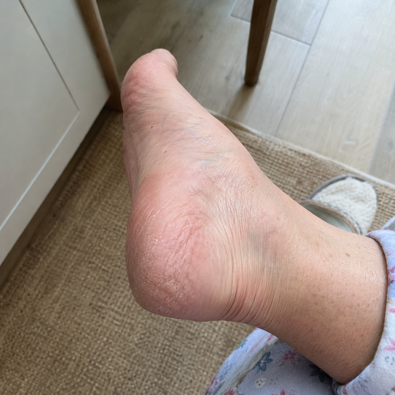 Sore Heels